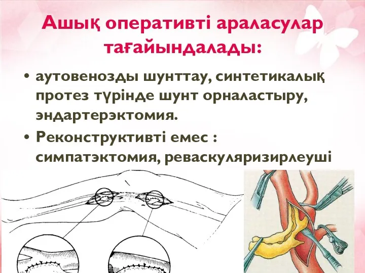 Ашық оперативті араласулар тағайындалады: аутовенозды шунттау, синтетикалық протез түрінде шунт