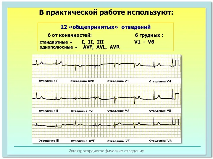 Электрокардиографические отведения 12 «общепринятых» отведений 6 от конечностей: 6 грудных