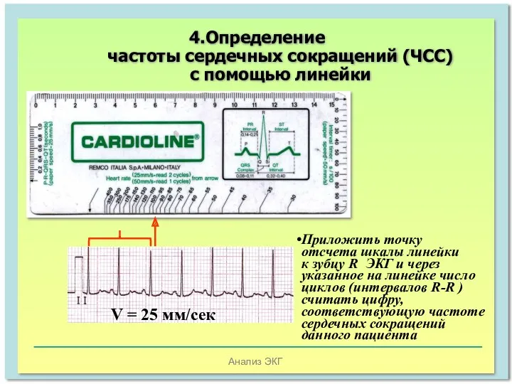Анализ ЭКГ Приложить точку отсчета шкалы линейки к зубцу R