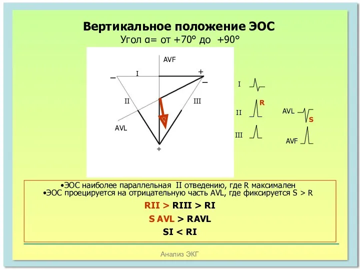 Анализ ЭКГ Вертикальное положение ЭОС Угол α= от +70° до