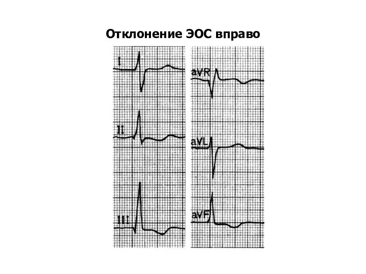 Отклонение ЭОС вправо