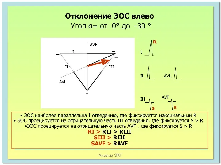 Анализ ЭКГ Отклонение ЭОС влево Угол α= от 0° до