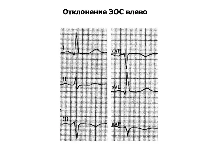 Отклонение ЭОС влево