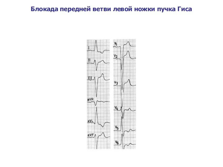 Блокада передней ветви левой ножки пучка Гиса