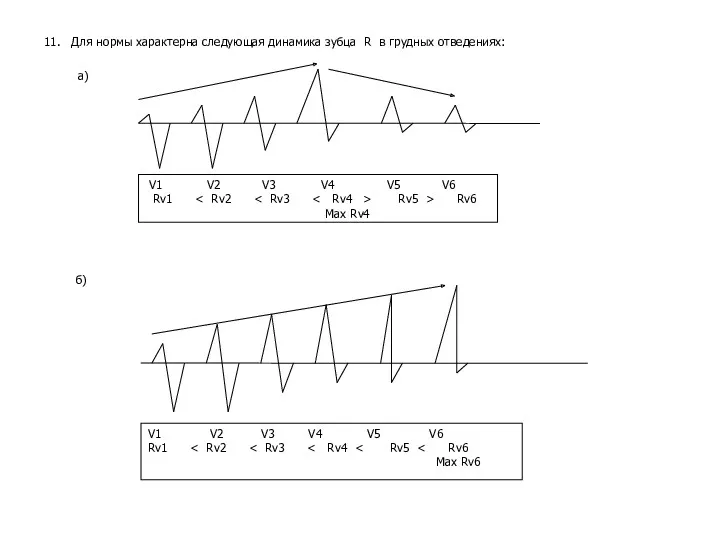 11. Для нормы характерна следующая динамика зубца R в грудных отведениях: а) б)