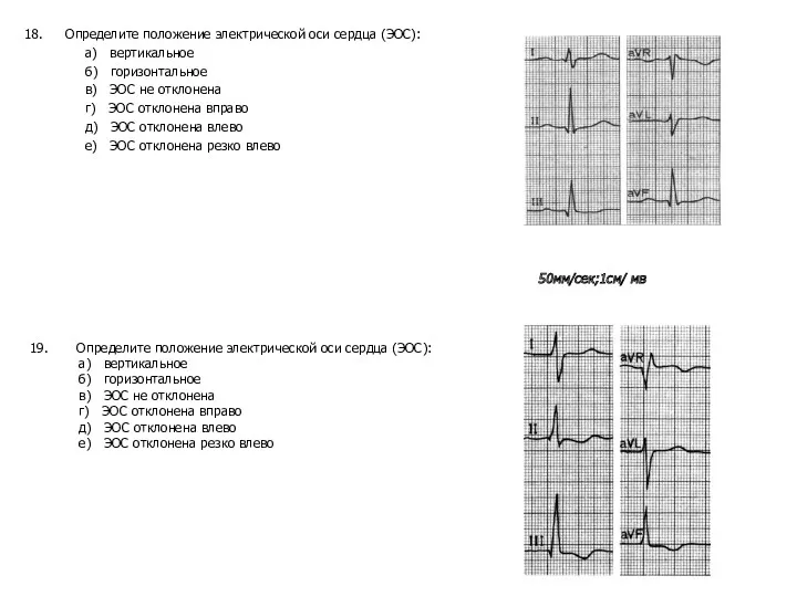 Определите положение электрической оси сердца (ЭОС): а) вертикальное б) горизонтальное