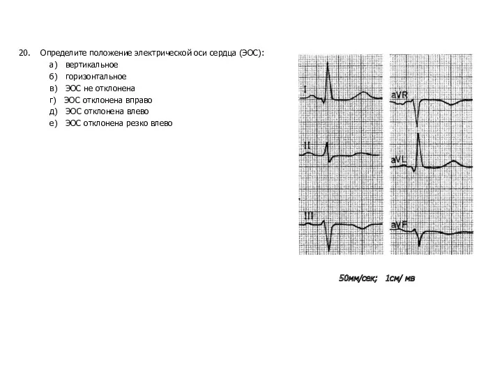 20. Определите положение электрической оси сердца (ЭОС): а) вертикальное б)