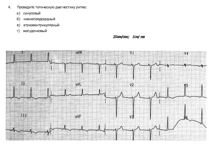 Проведите топическую диагностику ритма: а) синусовый б) нижнепредсердный в) атриовентрикулярный г) желудочковый 25мм/сек; 1см/ мв