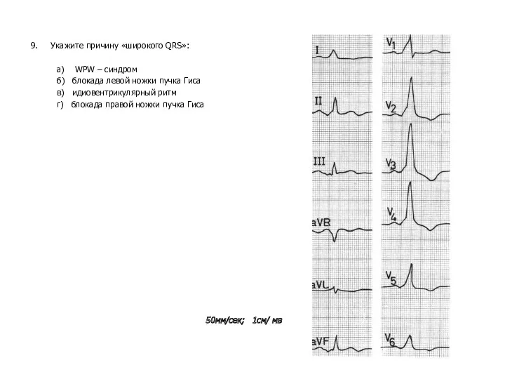 9. Укажите причину «широкого QRS»: а) WPW – синдром б)