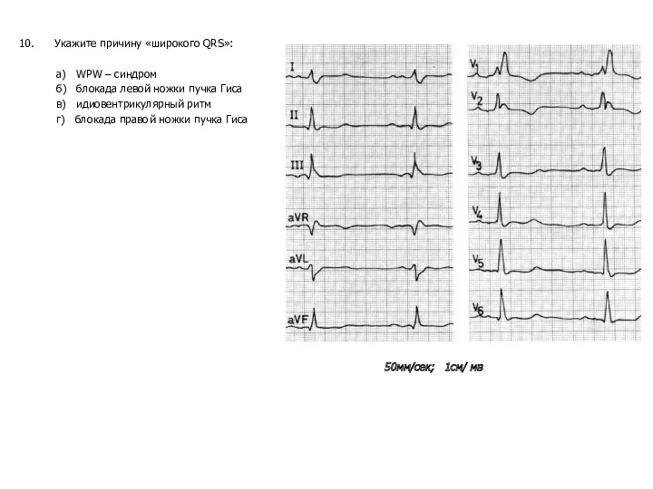 10. Укажите причину «широкого QRS»: а) WPW – синдром б)