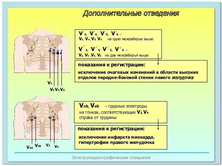 Электрокардиографические отведения Дополнительные отведения 1 2 4 5 6 1