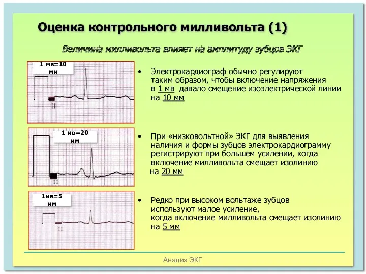 Анализ ЭКГ Оценка контрольного милливольта (1) Величина милливольта влияет на