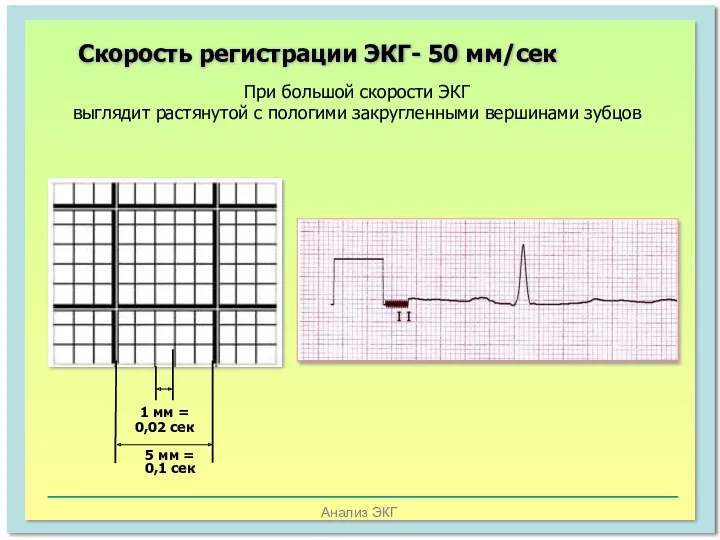 Анализ ЭКГ Скорость регистрации ЭКГ- 50 мм/сек При большой скорости