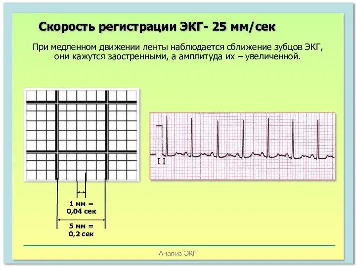 Анализ ЭКГ При медленном движении ленты наблюдается сближение зубцов ЭКГ,