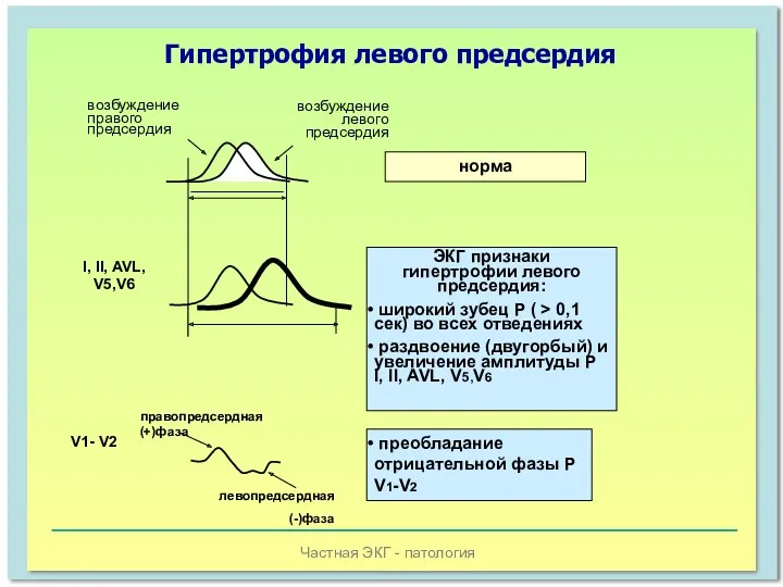 Частная ЭКГ - патология Гипертрофия левого предсердия возбуждение правого предсердия