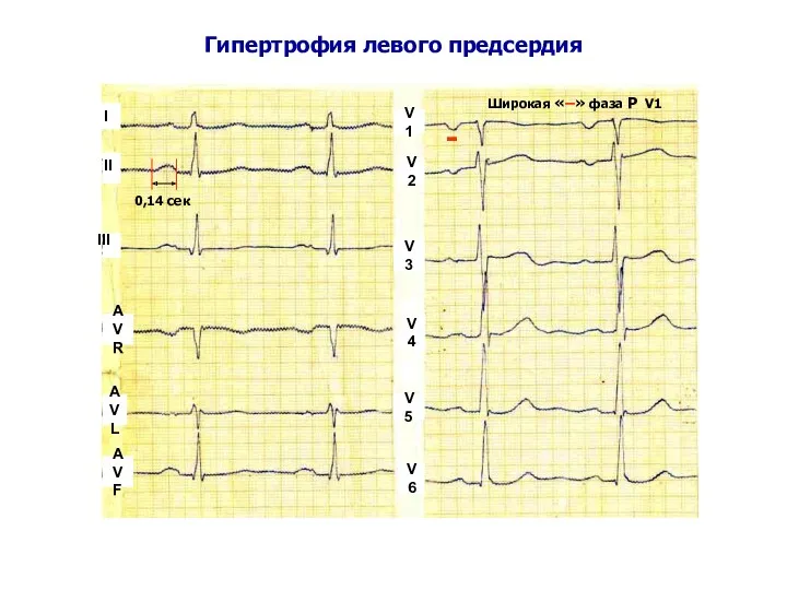 Гипертрофия левого предсердия 0,14 сек Широкая «–» фаза Р V1