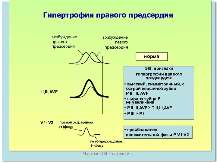 Частная ЭКГ - патология возбуждение правого предсердия возбуждение левого предсердия