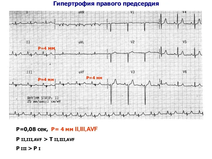 Гипертрофия правого предсердия Р=0,08 сек, Р= 4 мм II,III,AVF Р