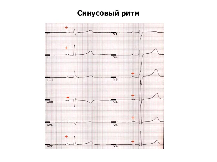 Синусовый ритм + + + + + + + -