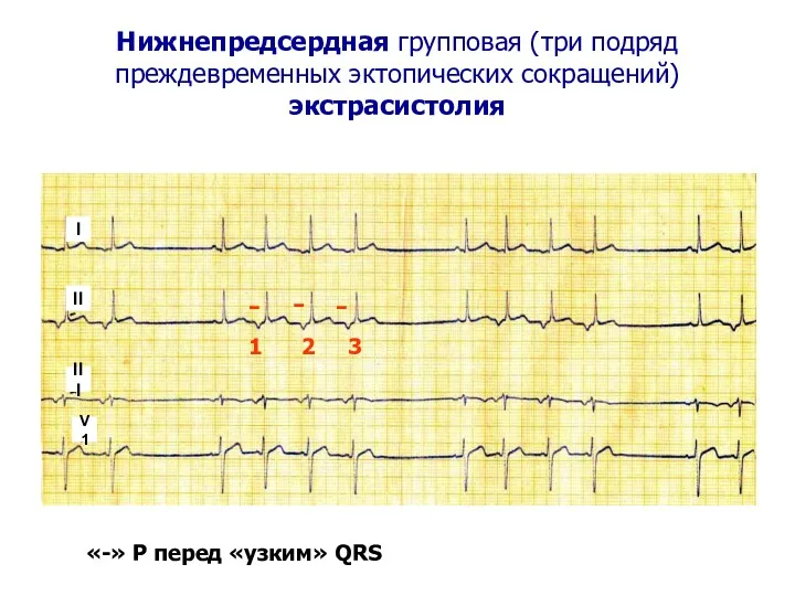Нижнепредсердная групповая (три подряд преждевременных эктопических сокращений) экстрасистолия - «-»