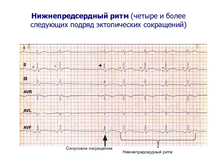 Нижнепредсердный ритм (четыре и более следующих подряд эктопических сокращений) I