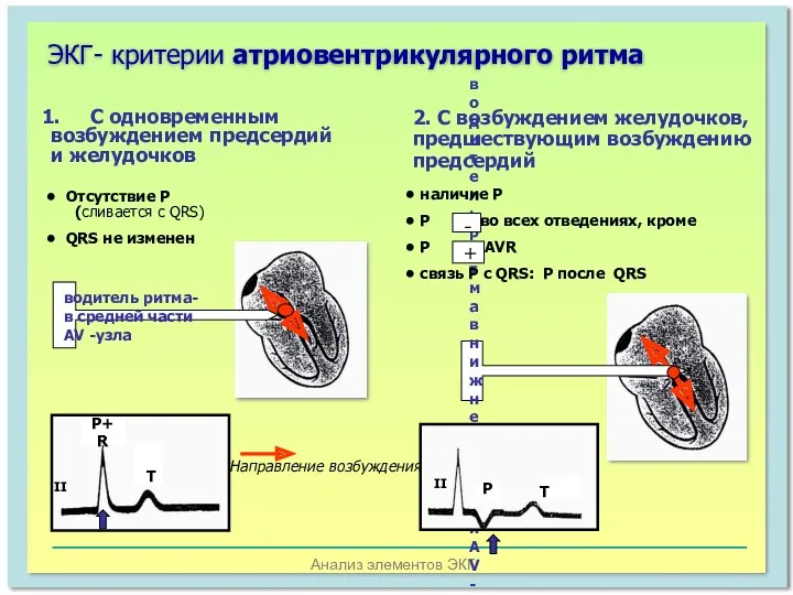 Анализ элементов ЭКГ ЭКГ- критерии атриовентрикулярного ритма С одновременным возбуждением