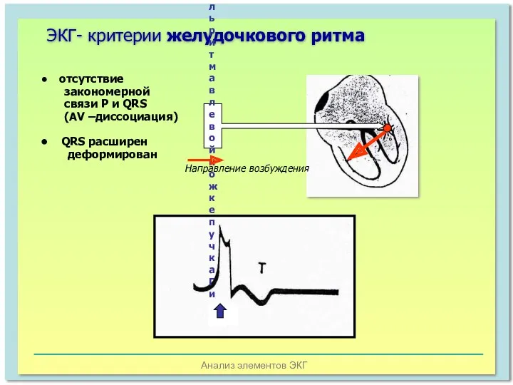 Анализ элементов ЭКГ ЭКГ- критерии желудочкового ритма водитель ритма в