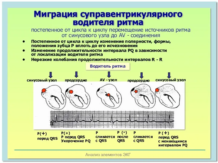 Анализ элементов ЭКГ Миграция суправентрикулярного водителя ритма постепенное от цикла