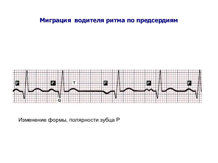 Миграция водителя ритма по предсердиям Изменение формы, полярности зубца Р