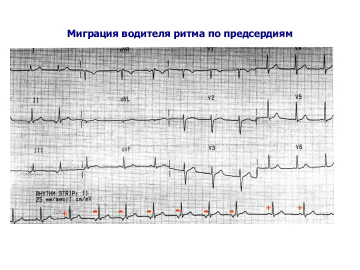 Миграция водителя ритма по предсердиям + + + - - - - - -