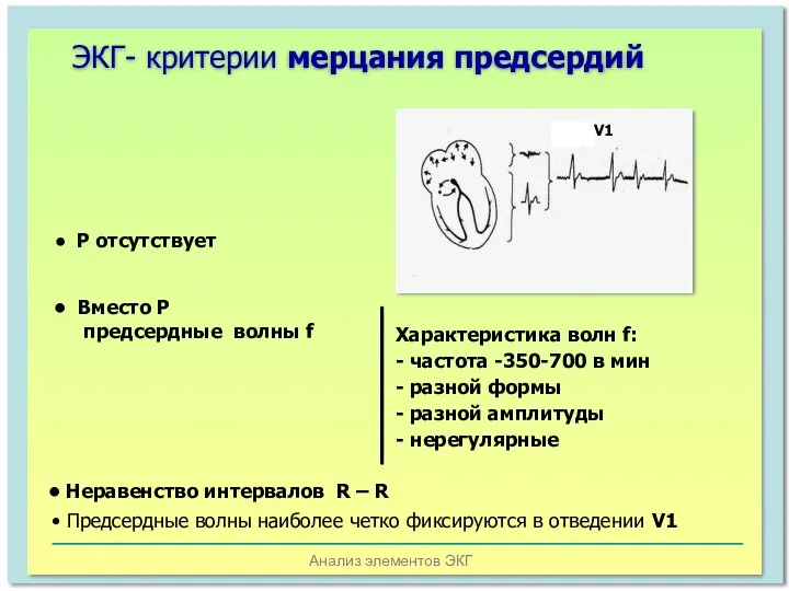 Анализ элементов ЭКГ ЭКГ- критерии мерцания предсердий Р отсутствует Вместо