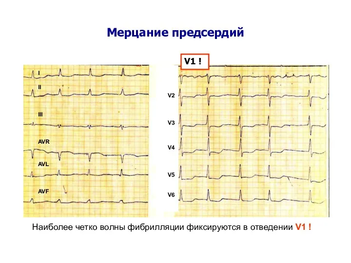 Мерцание предсердий V1 ! Наиболее четко волны фибрилляции фиксируются в