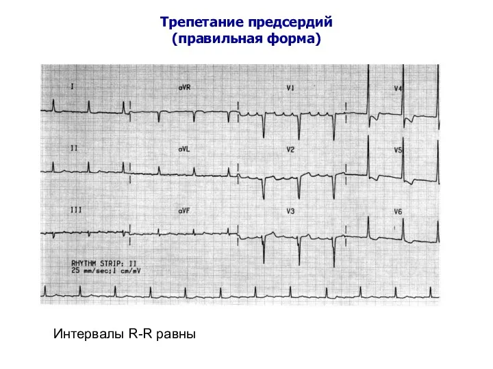 Трепетание предсердий (правильная форма) Интервалы R-R равны