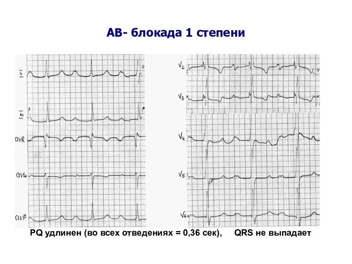 АВ- блокада 1 степени PQ удлинен (во всех отведениях = 0,36 сек), QRS не выпадает