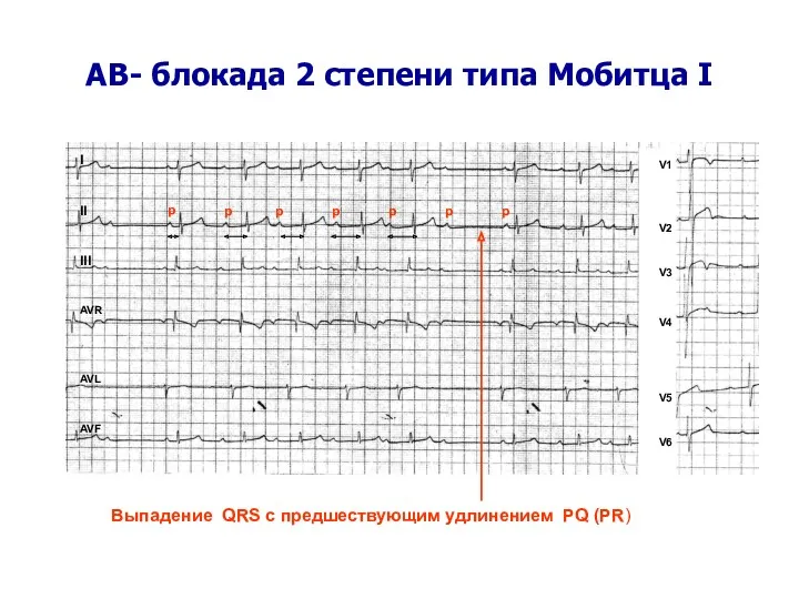 AВ- блокада 2 степени типа Мобитца I I II III