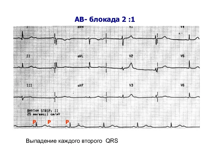 АВ- блокада 2 :1 Р Р Р Выпадение каждого второго QRS