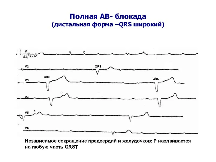 Полная АВ- блокада (дистальная форма –QRS широкий) V1 V2 V3