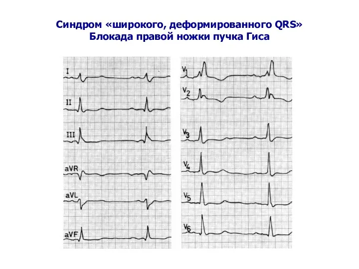 Синдром «широкого, деформированного QRS» Блокада правой ножки пучка Гиса