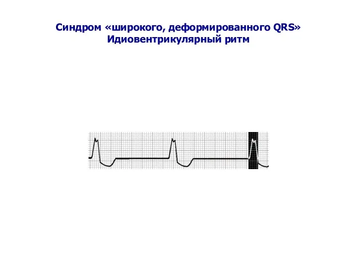 Синдром «широкого, деформированного QRS» Идиовентрикулярный ритм