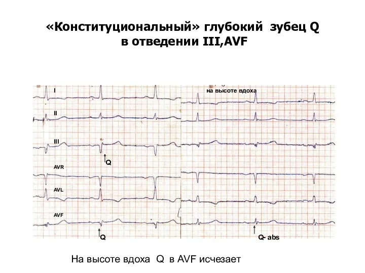 «Конституциональный» глубокий зубец Q в отведении III,AVF I II III