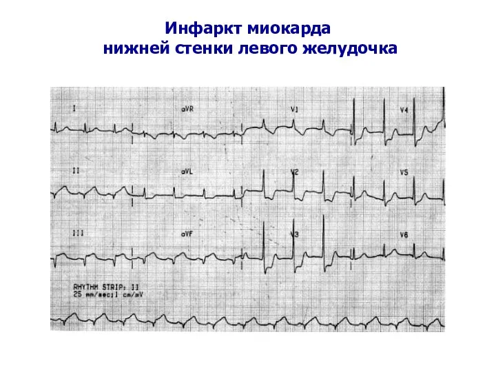 Инфаркт миокарда нижней стенки левого желудочка