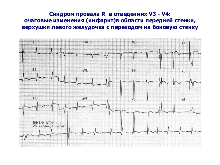 Синдром провала R в отведениях V3 - V4: очаговые изменения