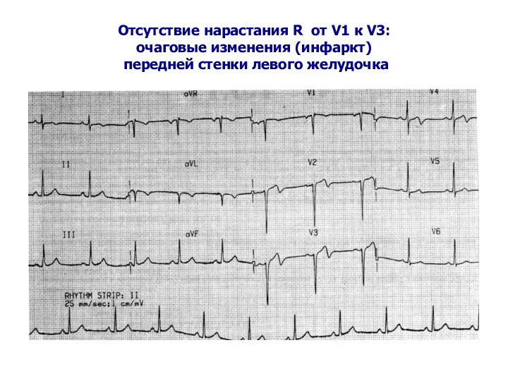 Отсутствие нарастания R от V1 к V3: очаговые изменения (инфаркт) передней стенки левого желудочка