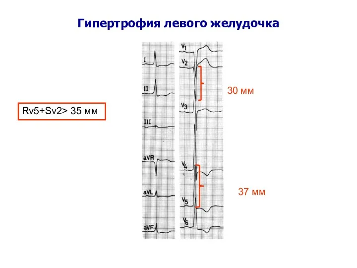 Гипертрофия левого желудочка 30 мм 37 мм Rv5+Sv2> 35 мм