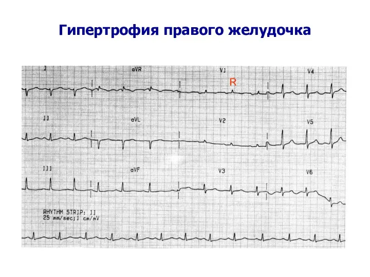 Гипертрофия правого желудочка R