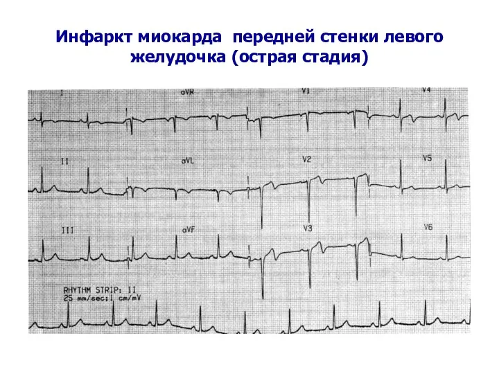 Инфаркт миокарда передней стенки левого желудочка (острая стадия)