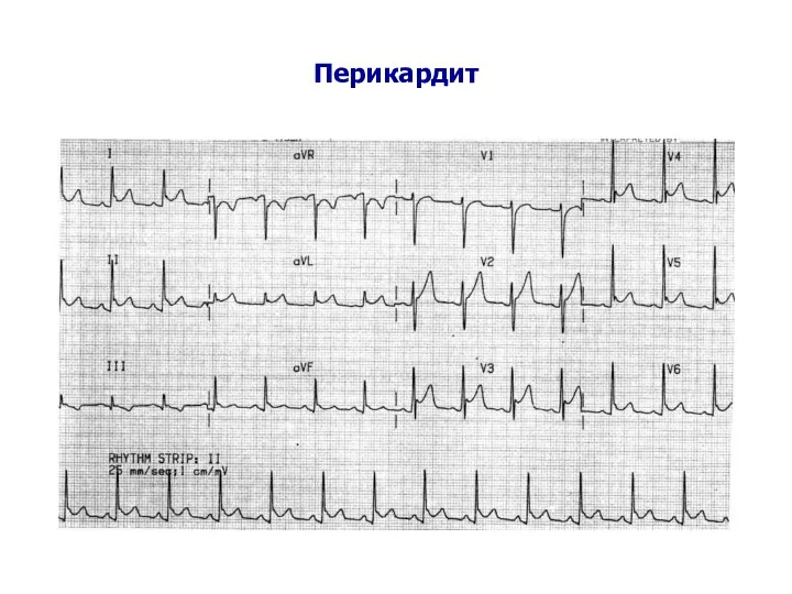 Перикардит