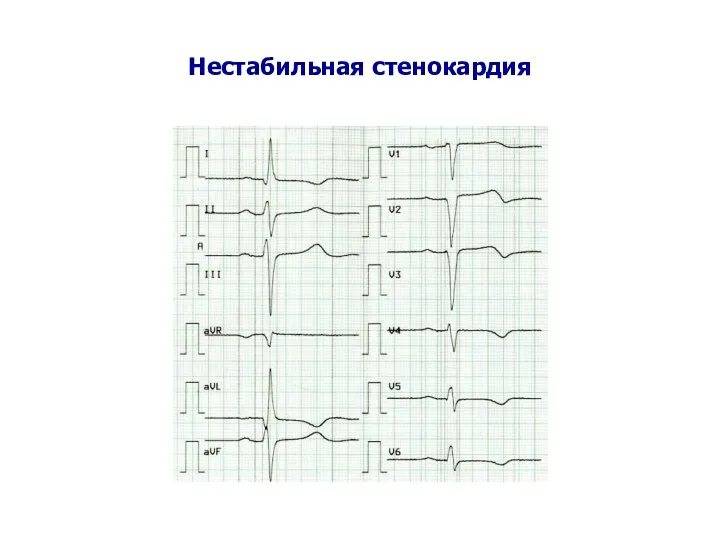 Нестабильная стенокардия