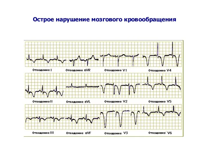 Острое нарушение мозгового кровообращения