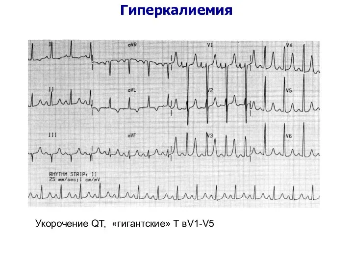 Гиперкалиемия Укорочение QT, «гигантские» Т вV1-V5